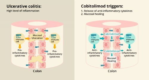 创新突破 新型抗炎药cobitolimod进入三期临床，TLR9激动剂为左半结肠溃疡性结肠炎治疗带来新希望